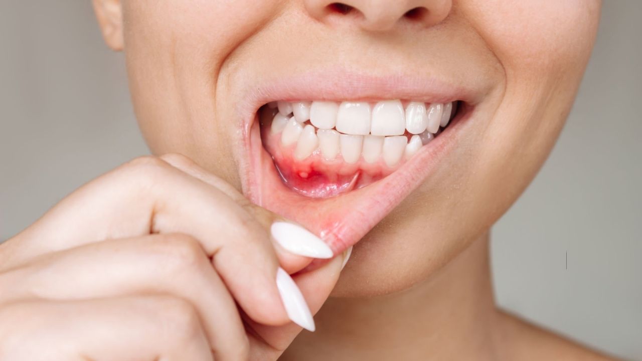 Descubra os tipos de piercing na boca e como cuidar - DentalVidas