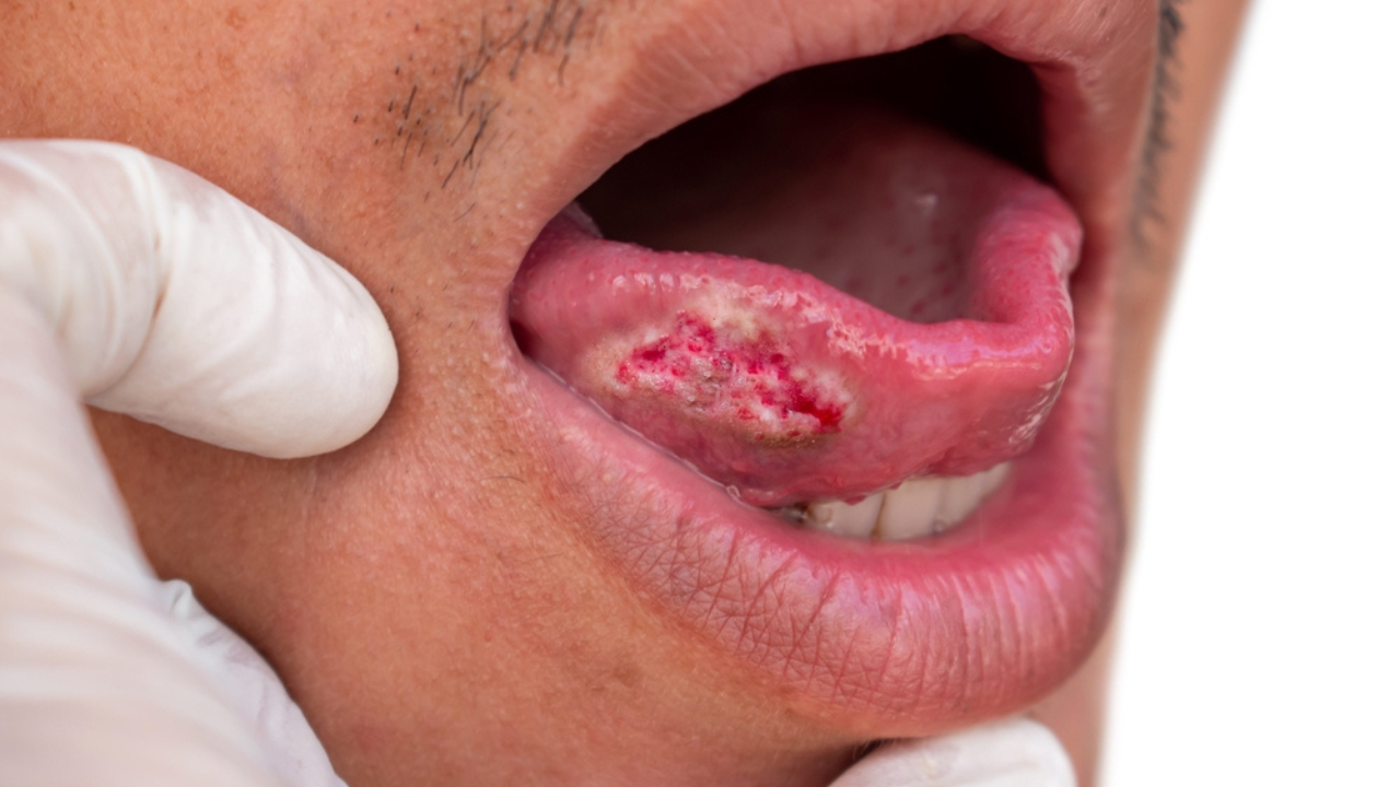Uma língua com ferimentos graves, que podem ser sinal de câncer na língua.