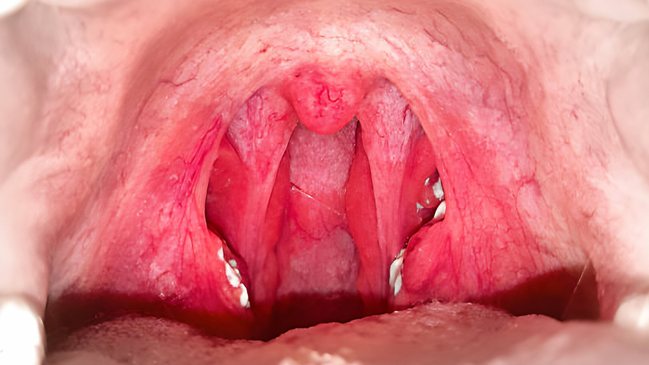 Fotografia de uma faringe extremamente infeccionada e com bolas de pus, sinais da presença de faringite estreptocócica.