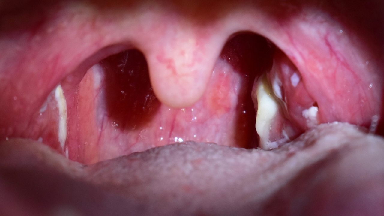 Uma garganta que apresenta presença de pus, devido à inflamações ou infecções.