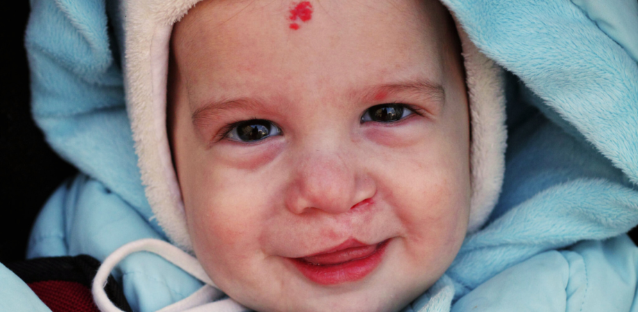 Um bebê que realizou cirurgia de correção de lábios leporinos, sorridente.