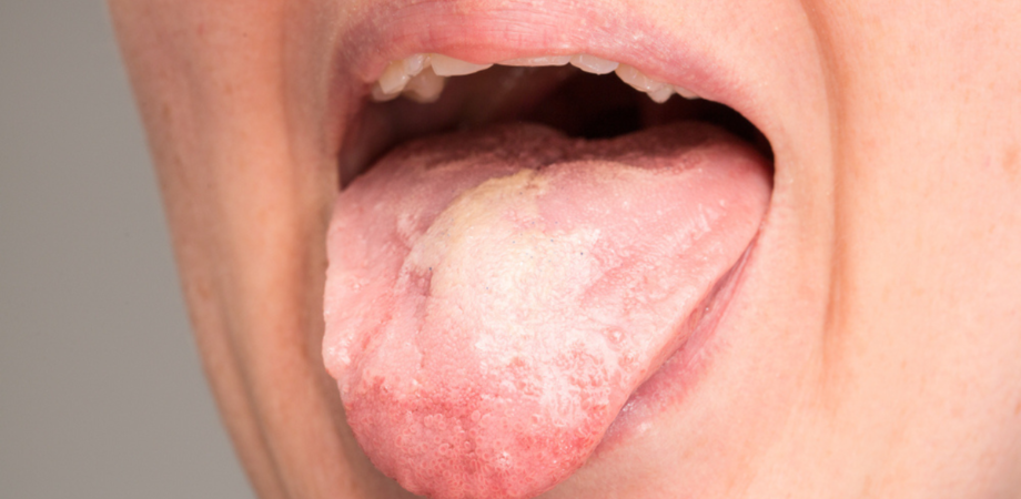 Uma língua esbranquiçada, sintoma de mucosite oral.