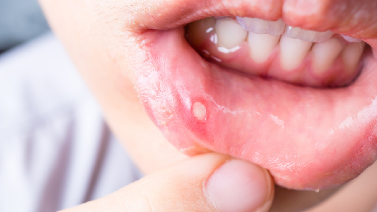Boca de paciente que apresenta presença de úlcera bucal, um dos sintomas da mucosite.