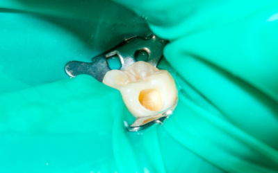 Um dente isolado durante procedimento de pulpectomia.