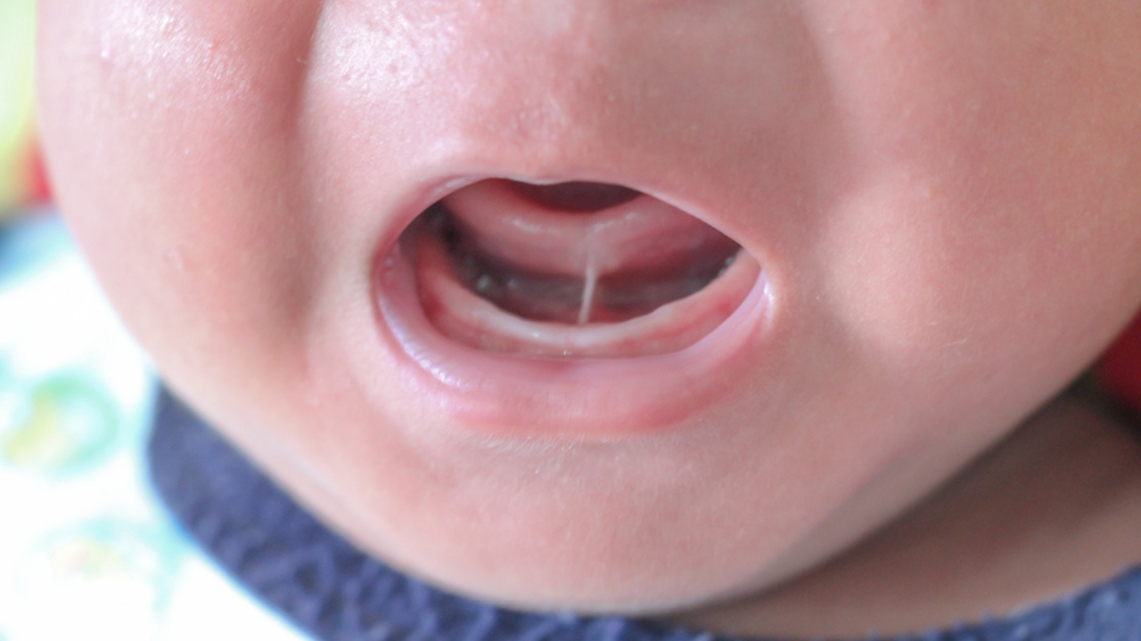 A boca de um bebê que apresenta a doença da língua presa.