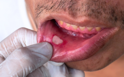 Uma boca de paciente com sinais de mucosite oral tratamento.