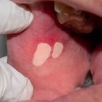 Médico avaliando úlceras características da mucosite em mucosa oral de paciente