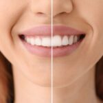 Foto mostrando antes e depois de tratamento de sorriso gengival